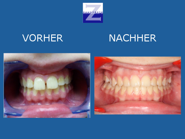 Vorher-Nachher-Behandlung mit Zahnspange