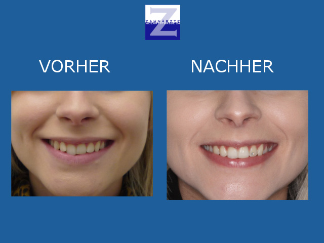 Vorher-Nachher-Behandlung mit Zahnspange