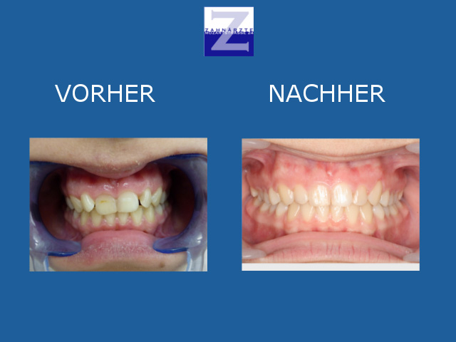 Vorher-Nachher-Behandlung mit Zahnspange