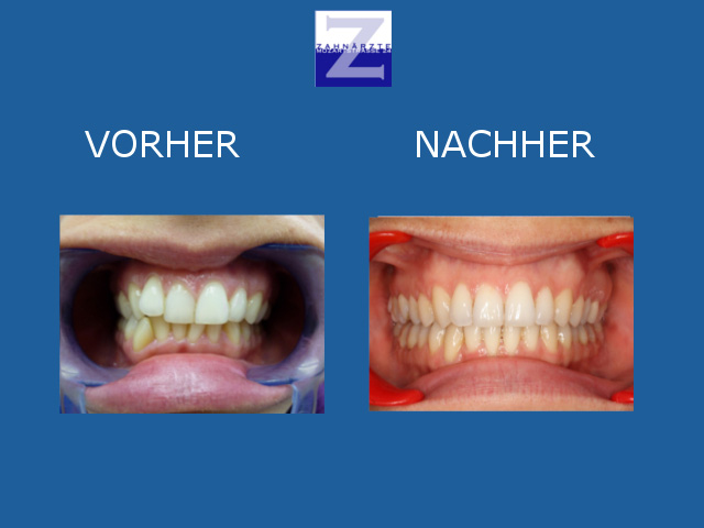 Vorher-Nachher-Behandlung mit Zahnspange