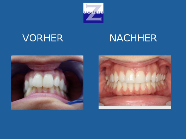 Vorher-Nachher-Behandlung mit Zahnspange