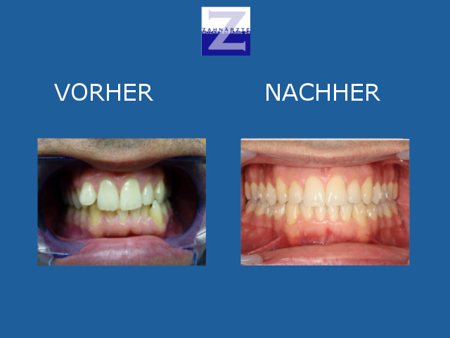 Vorher-Nachher-Behandlung mit Zahnspange