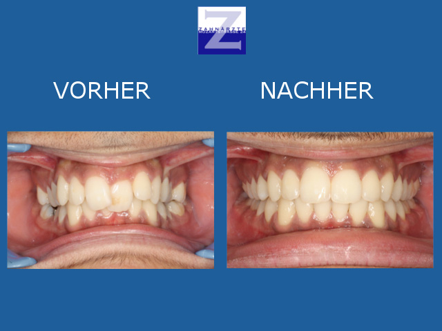 Vorher-Nachher-Behandlung mit Zahnspange