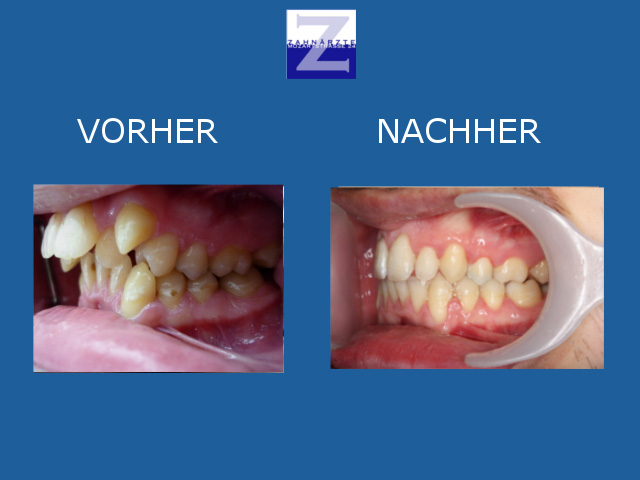 Vorher-Nachher-Behandlung mit Zahnspange