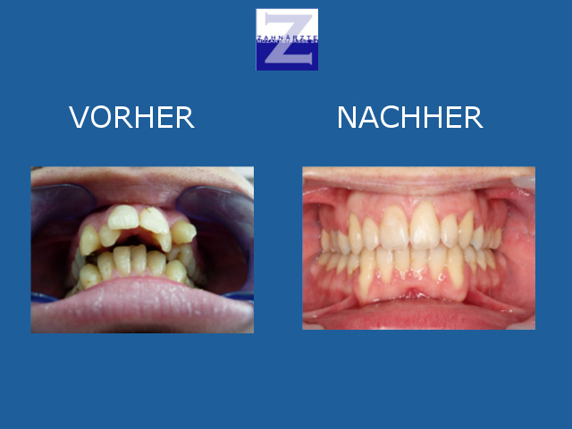 Vorher-Nachher-Behandlung mit Zahnspange