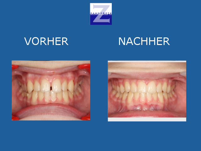 Vorher-Nachher-Behandlung mit Zahnspange