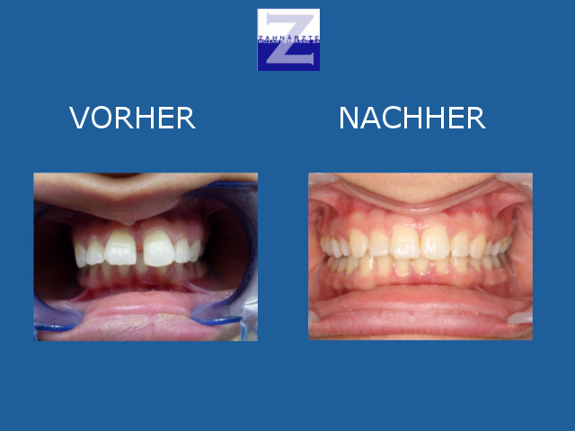 Vorher-Nachher-Behandlung mit Zahnspange