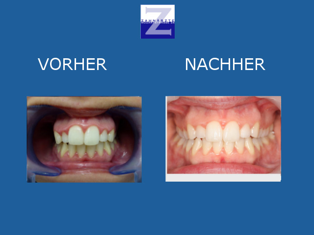Vorher-Nachher-Behandlung mit Zahnspange