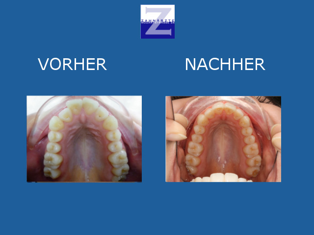 Vorher-Nachher-Behandlung mit Zahnspange